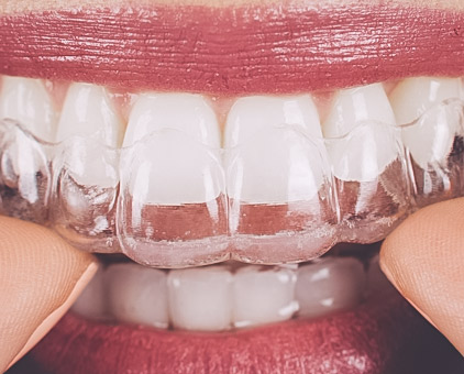 Invisalign Taquaral, na Qualis Clínica de Saúde, em Campinas