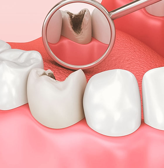 Cárie Dental - Taquaral, na Qualis Clínica de Saúde, em Campinas