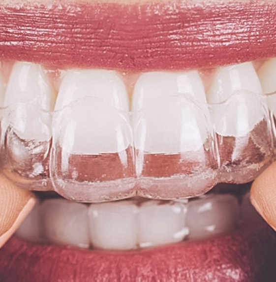 Invisalign - Taquaral, na Qualis Clínica de Saúde, em Campinas